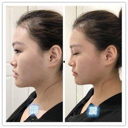 明星玻尿酸隆鼻,揭秘网红美鼻的秘密武器